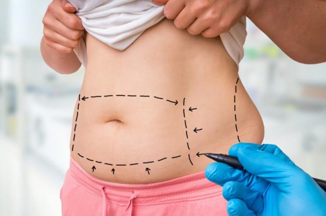 abdominoplastie