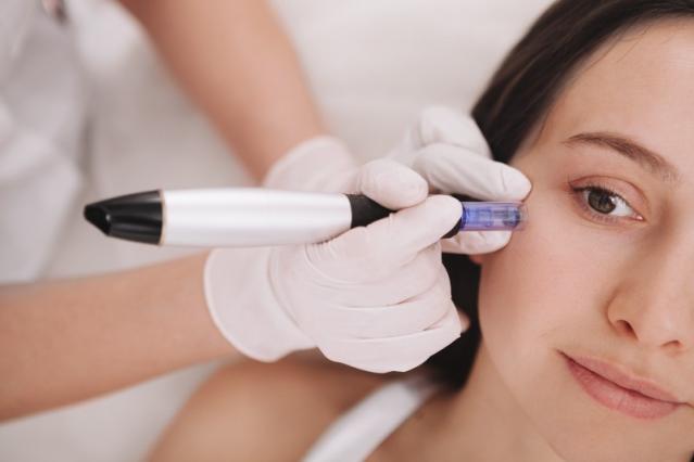 microneedling